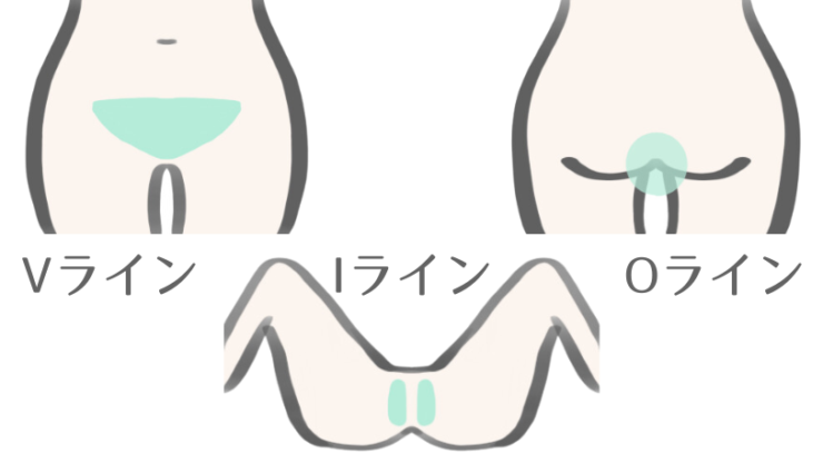 VIO脱毛の施術部分