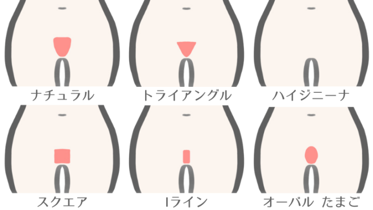 VIO脱毛のデザイン